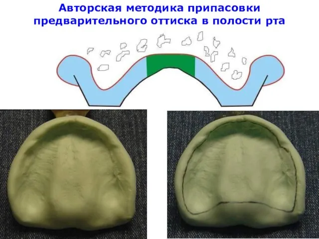 Авторская методика припасовки предварительного оттиска в полости рта