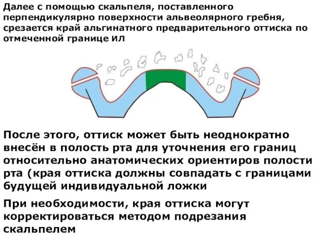 Далее с помощью скальпеля, поставленного перпендикулярно поверхности альвеолярного гребня, срезается край