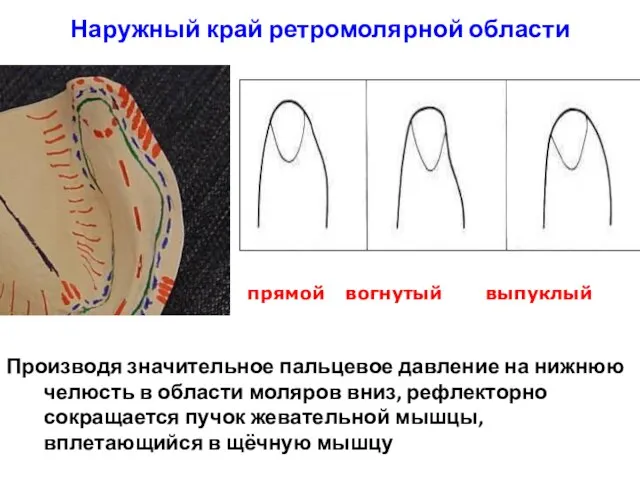 Наружный край ретромолярной области Производя значительное пальцевое давление на нижнюю челюсть