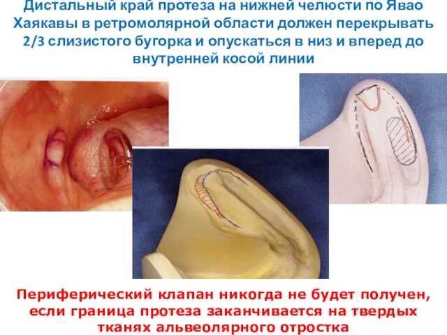 Дистальный край протеза на нижней челюсти по Явао Хаякавы в ретромолярной