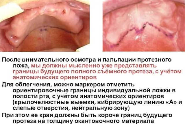 После внимательного осмотра и пальпации протезного ложа, мы должны мысленно уже