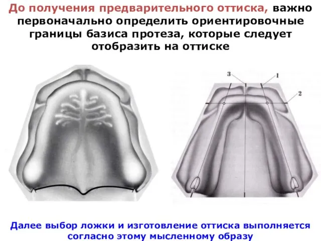 До получения предварительного оттиска, важно первоначально определить ориентировочные границы базиса протеза,