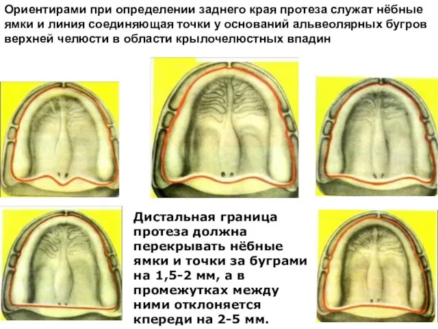 Ориентирами при определении заднего края протеза служат нёбные ямки и линия