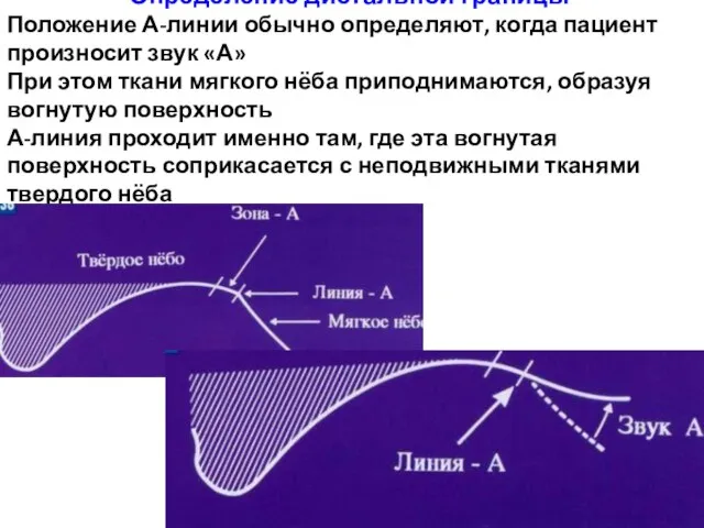 Определение дистальной границы Положение А-линии обычно определяют, когда пациент произносит звук