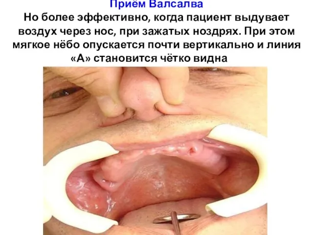 Приём Валсалва Но более эффективно, когда пациент выдувает воздух через нос,