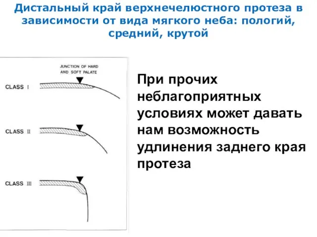 Дистальный край верхнечелюстного протеза в зависимости от вида мягкого неба: пологий,