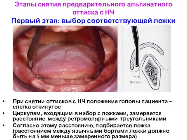 Этапы снятия предварительного альгинатного оттиска с НЧ Первый этап: выбор соответствующей