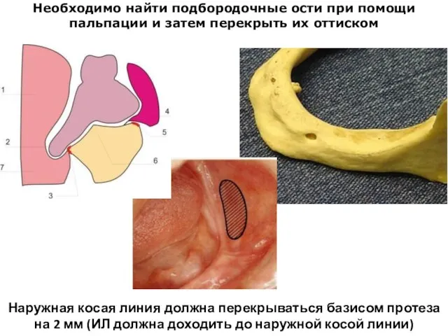 Наружная косая линия должна перекрываться базисом протеза на 2 мм (ИЛ