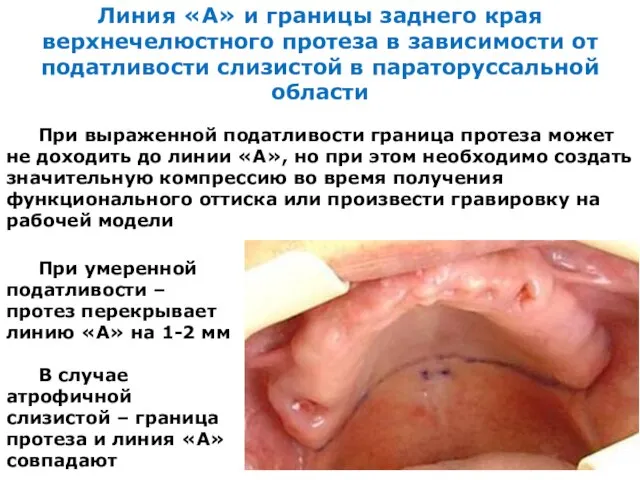Линия «А» и границы заднего края верхнечелюстного протеза в зависимости от