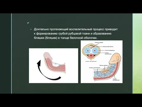 Длительно протекающий воспалительный процесс приводит к формированию грубой рубцовой ткани и