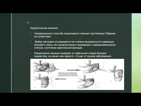 Хирургическое лечение Универсального способа оперативного лечения при болезни Пейрони не существует.