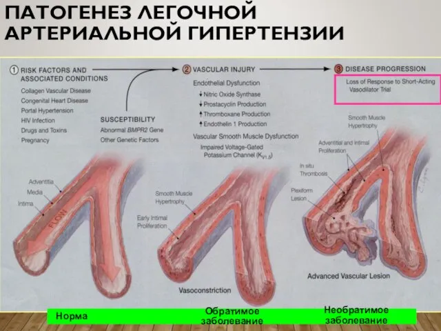 ПАТОГЕНЕЗ ЛЕГОЧНОЙ АРТЕРИАЛЬНОЙ ГИПЕРТЕНЗИИ Норма Обратимое заболевание Необратимое заболевание