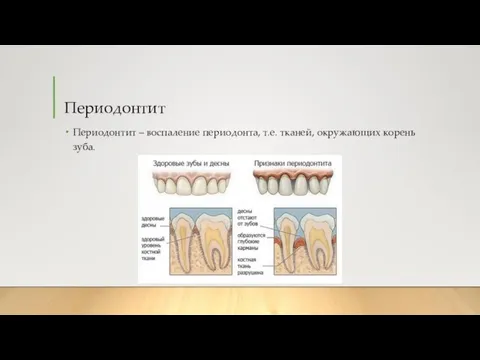 Периодонтит Периодонтит – воспаление периодонта, т.е. тканей, окружающих корень зуба.