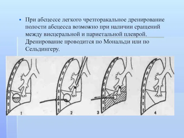 При абсцессе легкого чрезторакальное дренирование полости абсцесса возможно при наличии сращений