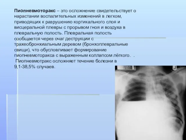 Пиопневмоторакс – это осложнение свидетельствует о нарастании воспалительных изменений в легком,