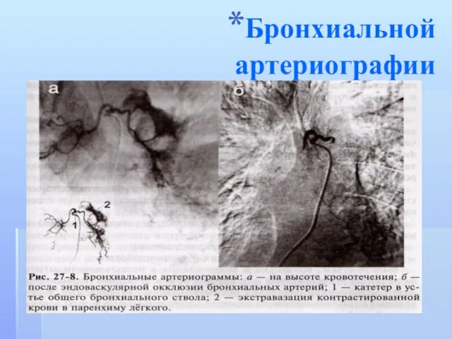 Бронхиальной артериографии