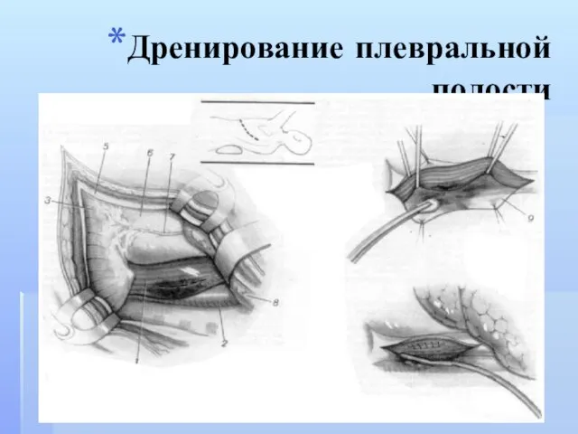 Дренирование плевральной полости