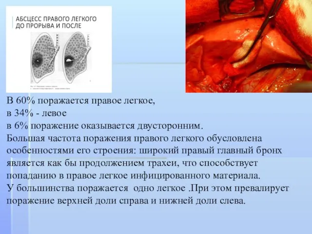 В 60% поражается правое легкое, в 34% - левое в 6%