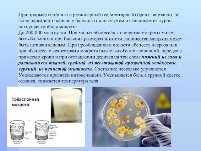 При прорыве гнойника в регионарный (сегментарный) бронх: внезапно, на фоне надсадного