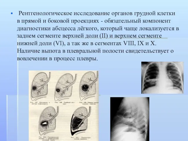 Рентгенологическое исследование органов грудной клетки в прямой и боковой проекциях -