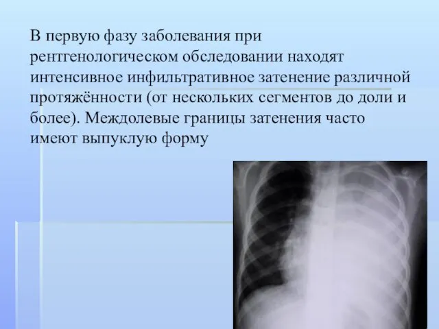 В первую фазу заболевания при рентгенологическом обследовании находят интенсивное инфильтративное затенение