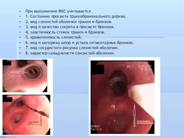 При выполнении ФБС учитывается 1. Состояние просвета трахеобронхиального дерева. 2. вид
