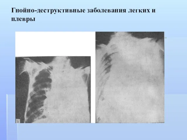 Гнойно-деструктивные заболевания легких и плевры