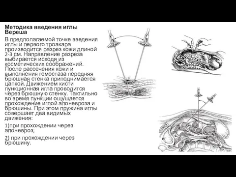 Методика введения иглы Вереша В предполагаемой точке введения иглы и первого