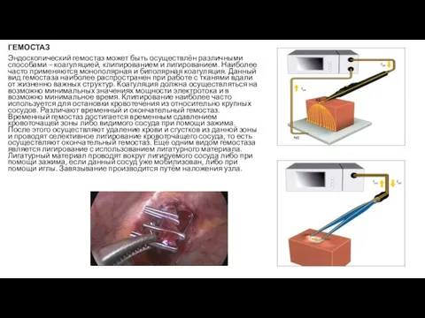 ГЕМОСТАЗ Эндоскопический гемостаз может быть осуществлён различными способами – коагуляцией, клипированием
