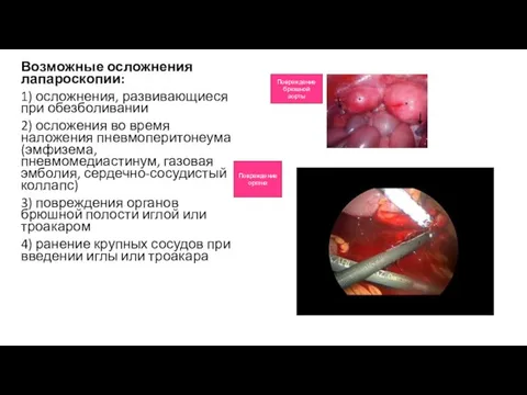 Возможные осложнения лапароскопии: 1) осложнения, развивающиеся при обезболивании 2) осложения во