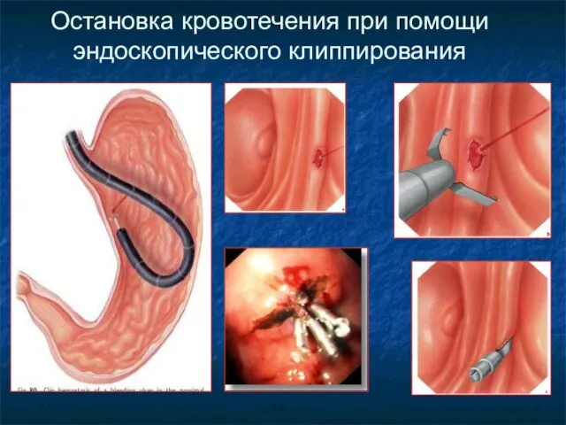 Остановка кровотечения при помощи эндоскопического клиппирования