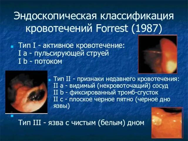 Эндоскопическая классификация кровотечений Forrest (1987) Тип I - активное кровотечение: I