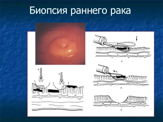 Биопсия раннего рака