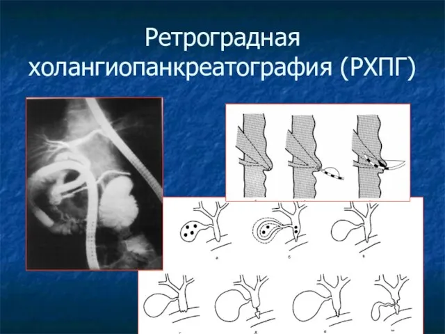 Ретроградная холангиопанкреатография (РХПГ)