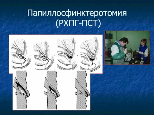 Папиллосфинктеротомия (РХПГ-ПСТ)