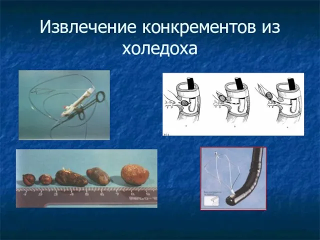 Извлечение конкрементов из холедоха