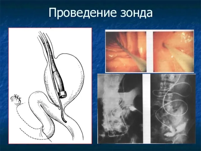 Проведение зонда