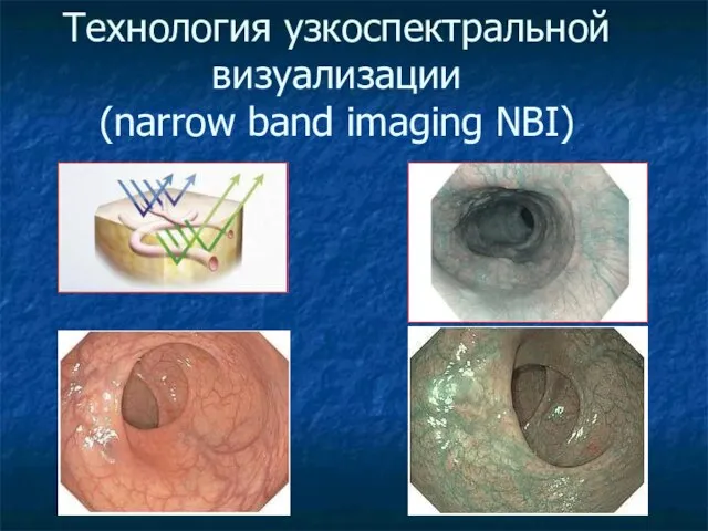 Технология узкоспектральной визуализации (narrow band imaging NBI)