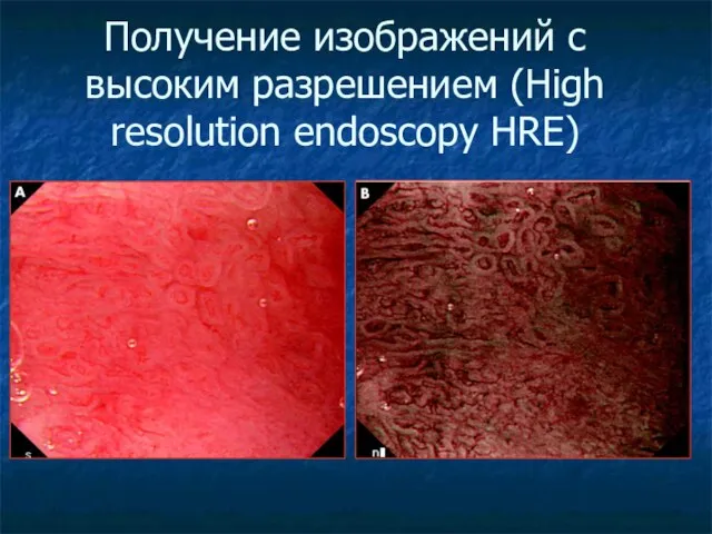 Получение изображений с высоким разрешением (High resolution endoscopy HRE)