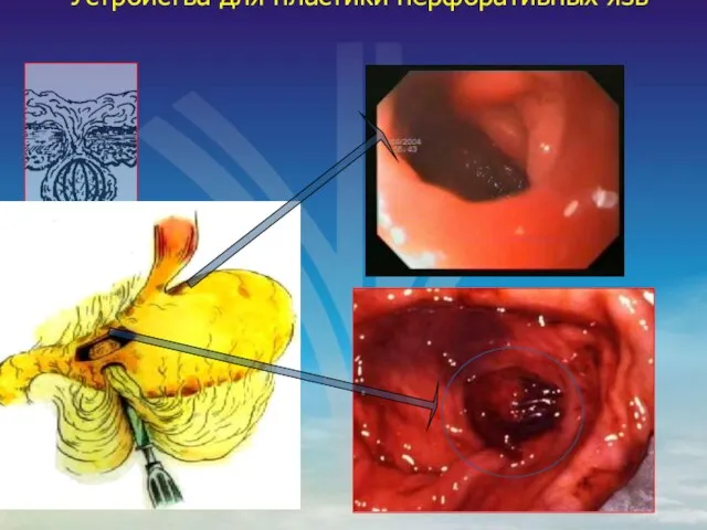 Устройства для пластики перфоративных язв