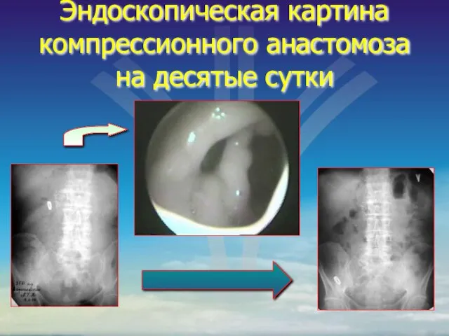 Эндоскопическая картина компрессионного анастомоза на десятые сутки