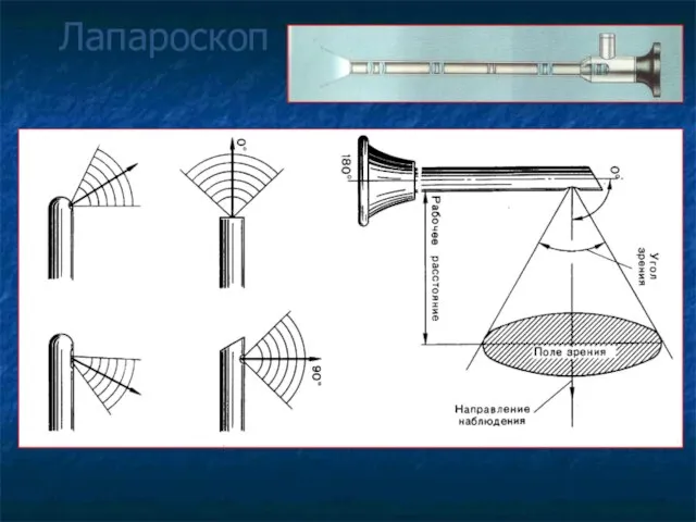 Лапароскоп