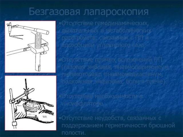 Безгазовая лапароскопия Отсутствие гемодинамических, дыхательных и метаболических расстройств, связанных с ПП