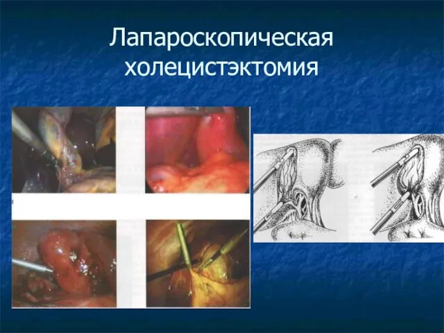 Лапароскопическая холецистэктомия