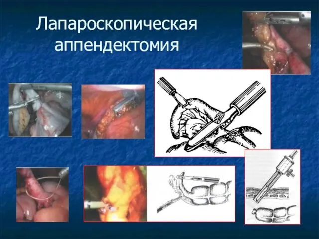 Лапароскопическая аппендектомия