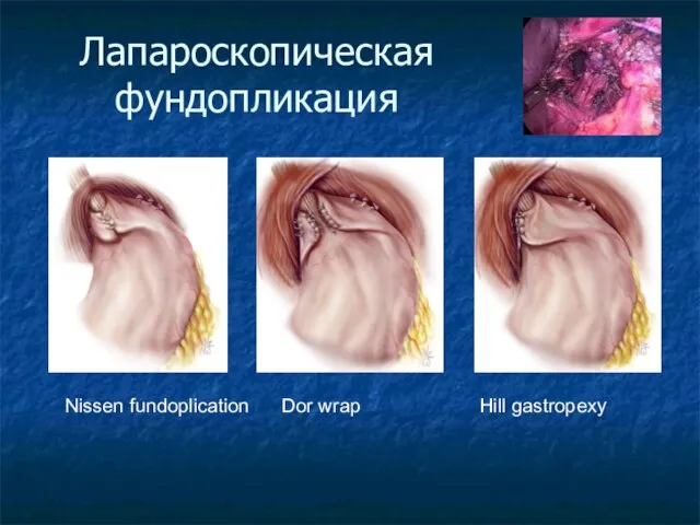 Лапароскопическая фундопликация Nissen fundoplication Dor wrap Hill gastropexy