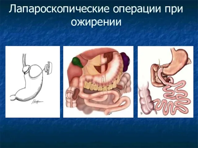 Лапароскопические операции при ожирении