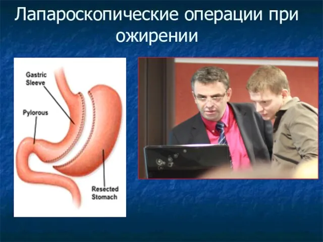 Лапароскопические операции при ожирении