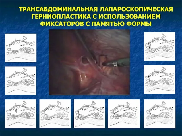 ТРАНСАБДОМИНАЛЬНАЯ ЛАПАРОСКОПИЧЕСКАЯ ГЕРНИОПЛАСТИКА С ИСПОЛЬЗОВАНИЕМ ФИКСАТОРОВ С ПАМЯТЬЮ ФОРМЫ