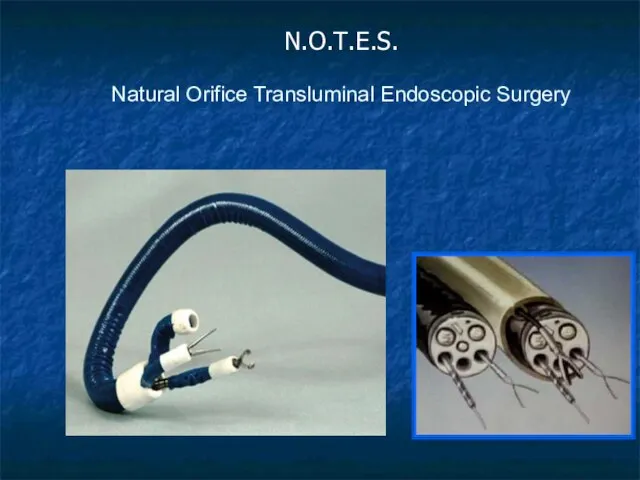 N.O.T.E.S. Natural Orifice Transluminal Endoscopic Surgery